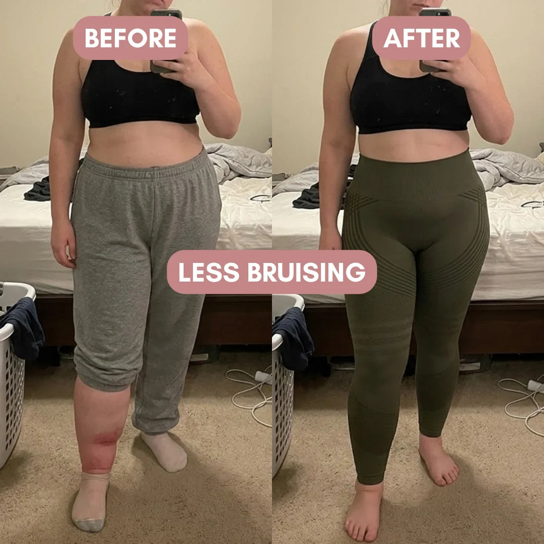 Naya 3D Legging – Say goodbye to lipoedema pain and swelling naturally